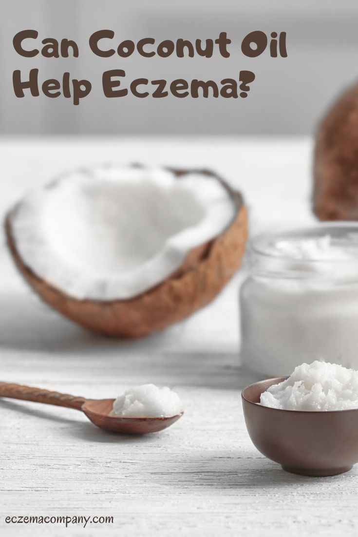 Can Coconut Oil Help Eczema? in 2020