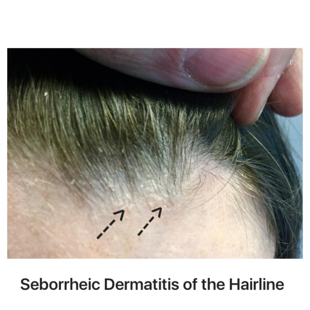 Can drugs cause or exacerbate seborrheic dermatitis? â Donovan Hair Clinic
