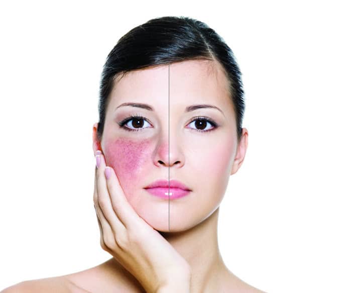 Can eczema cause skin lightening ~ Top Secret Skin Tips