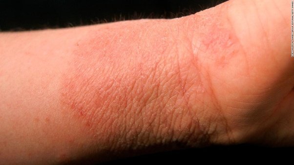 Can overuse of steroid creams and ointments make eczema ...