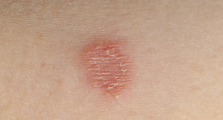 Can Ringworm Spread to Other Parts of the Body ...