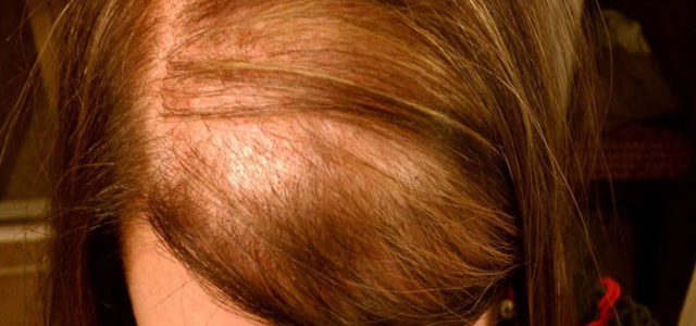Can Scalp Eczema Cause Hair Loss