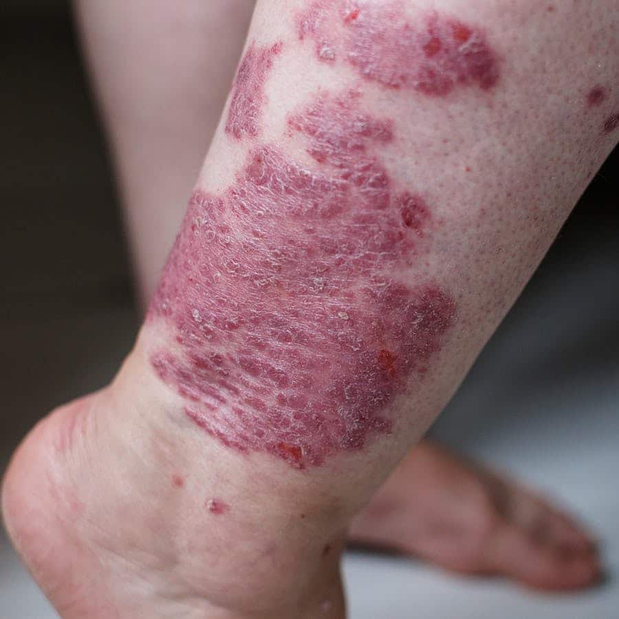 Can You Clear Eczema by Avoiding Triggers?