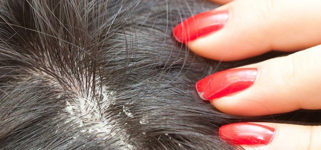 Can You Get Eczema In Your Scalp