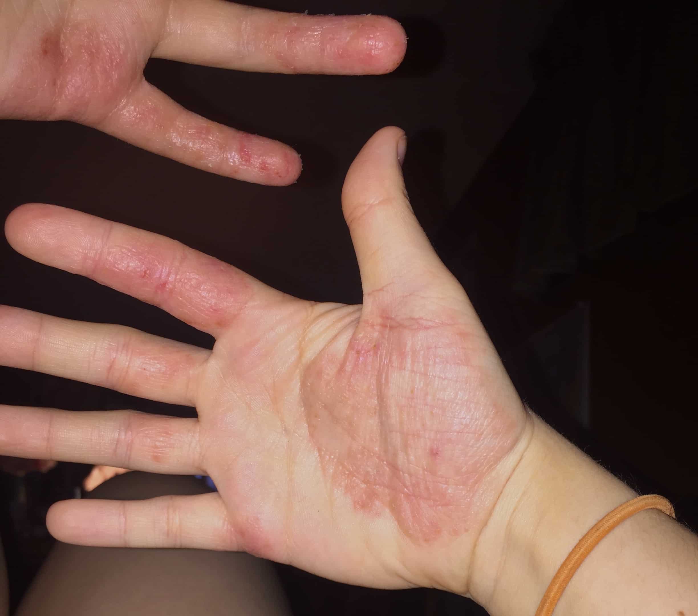 Can You Get Eczema On Your Hands