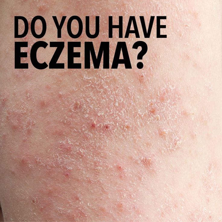 Can You Have Eczema On Your Lips