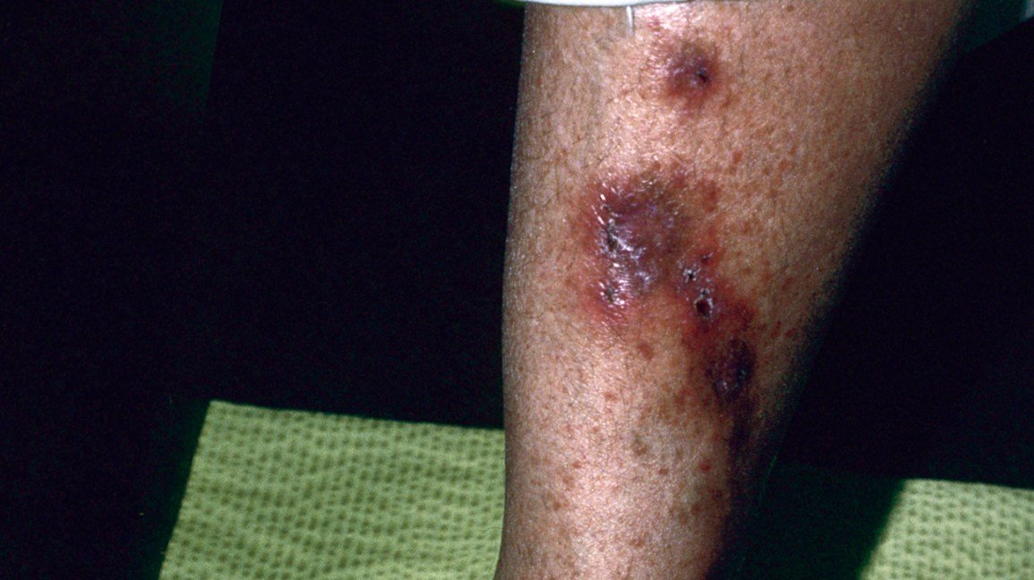Causes of a red circle on the skin other than ringworm