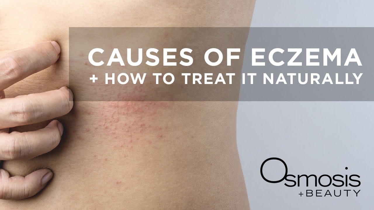 Causes of Eczema and How to Treat It Naturally