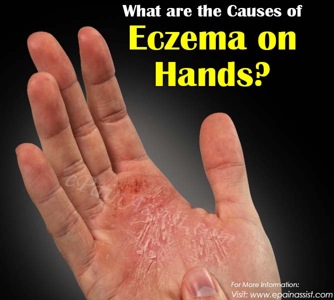 Causes of Eczema on Hands &  Its Treatment