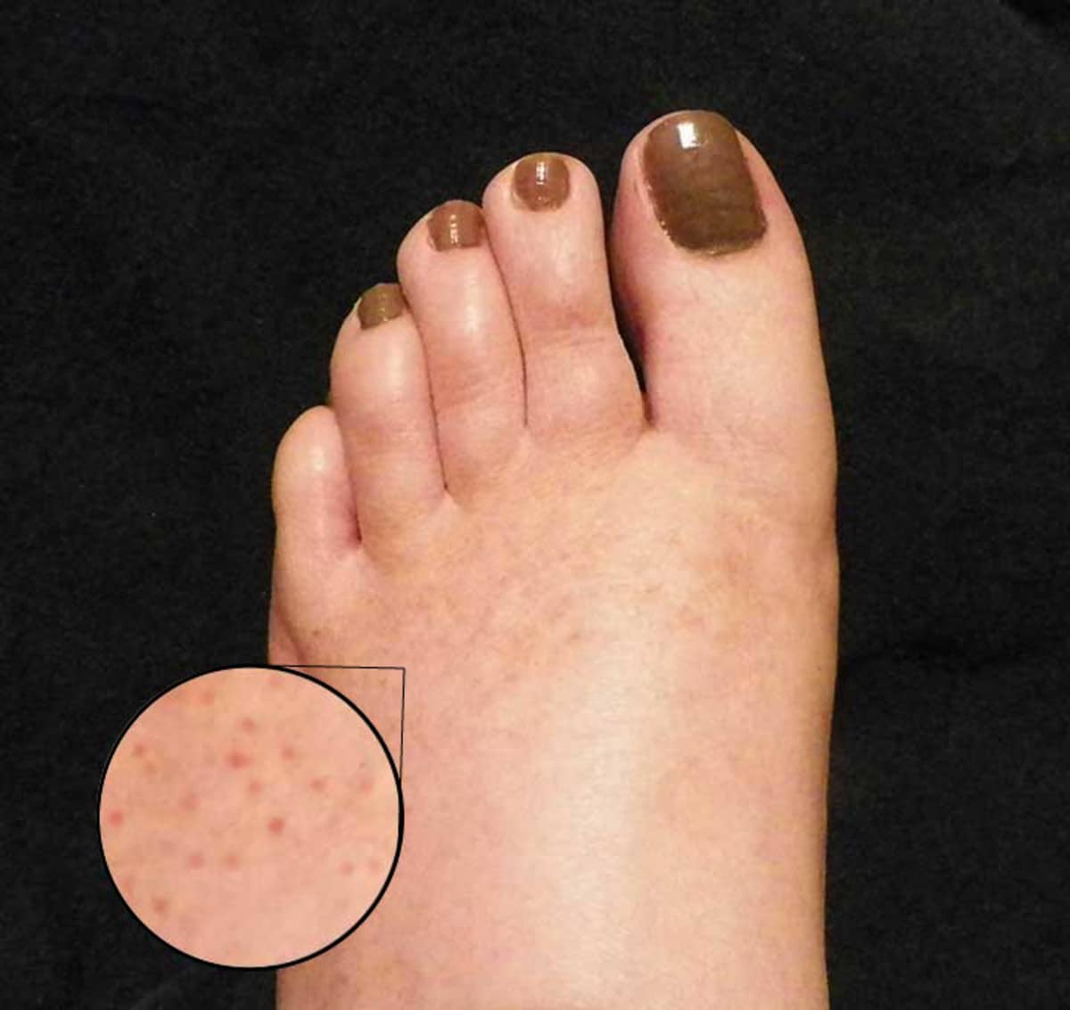 Causes of Red Dots on Feet
