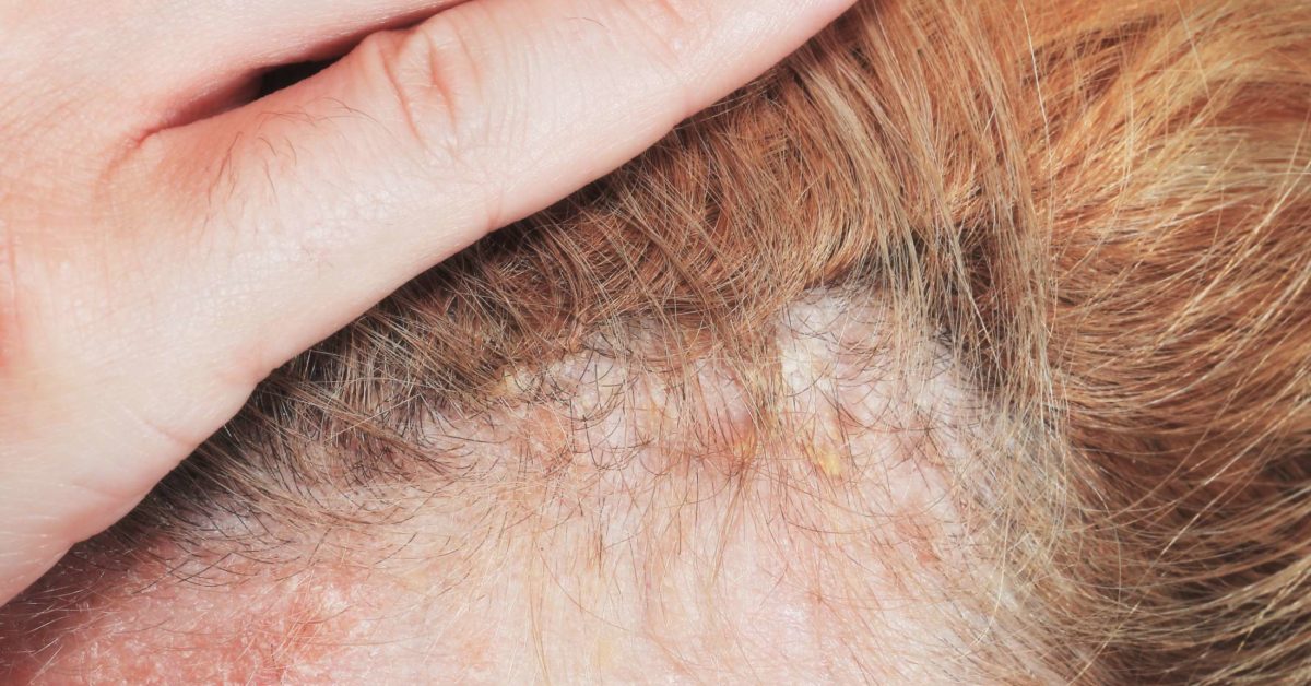 Causes of Scaling in the Scalp