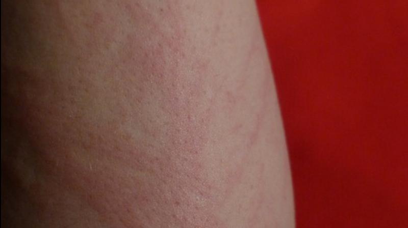 Certain kind of body rashes could indicate cancer