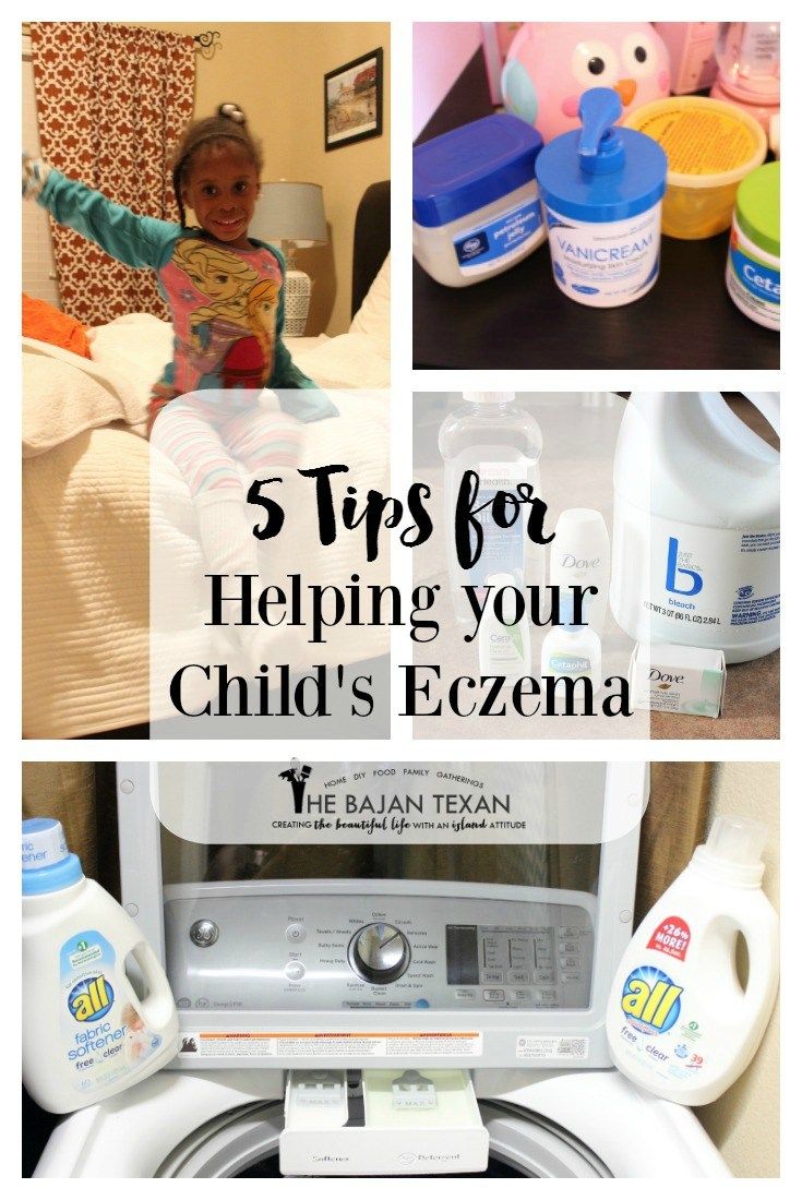 Child Eczema: 5 Ways to Help Your Child Today â The Bajan ...