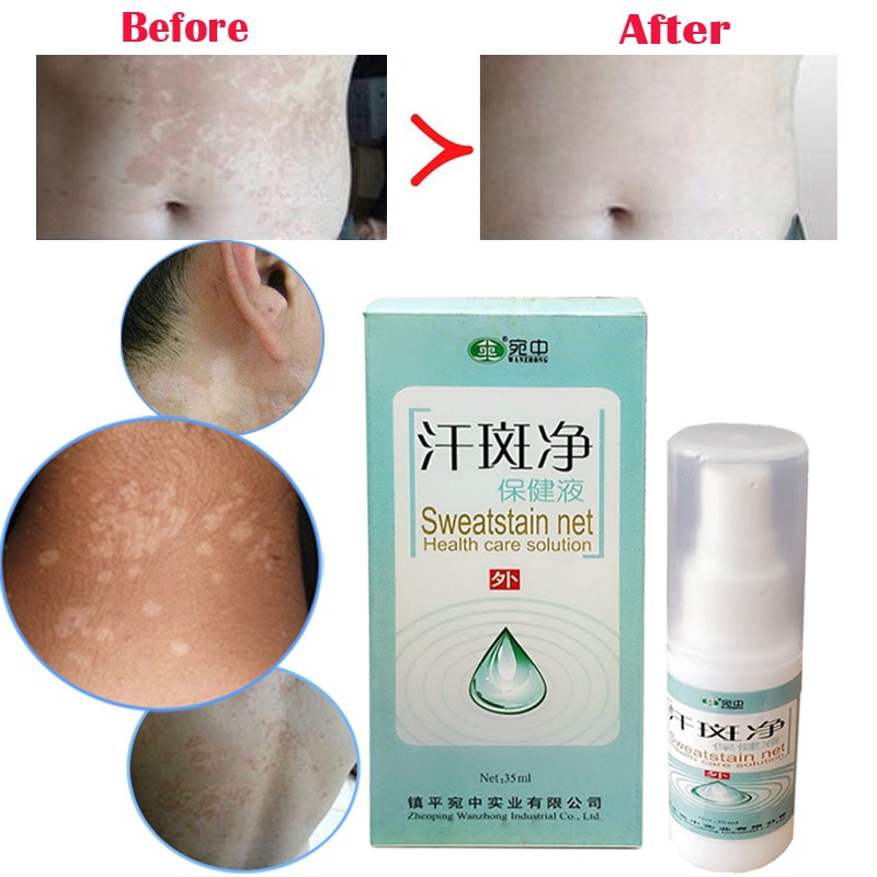 Chinese Herbal Medicine Spray Professional Treatment For Skin White ...