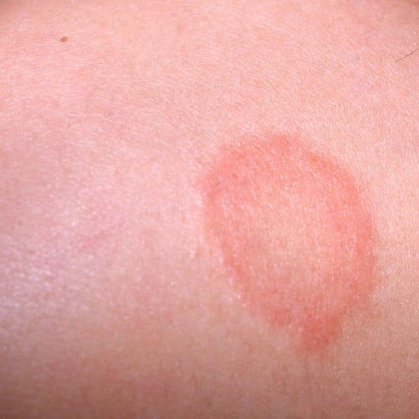 circular rash on neck