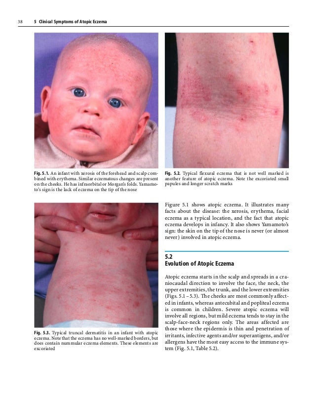 Clinical symptoms of eczema