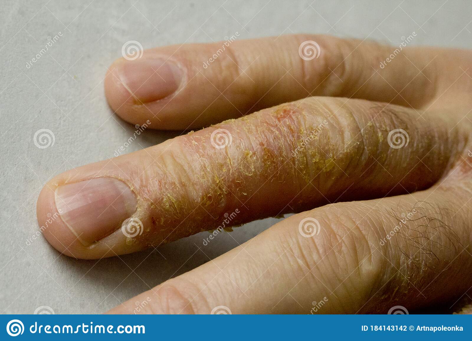 Closeup Of Eczema Dermatitis On Man Hand And Fingers. Skin ...