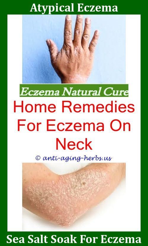 Common Causes Of Eczema Moisturizing Ointment For Eczema ...