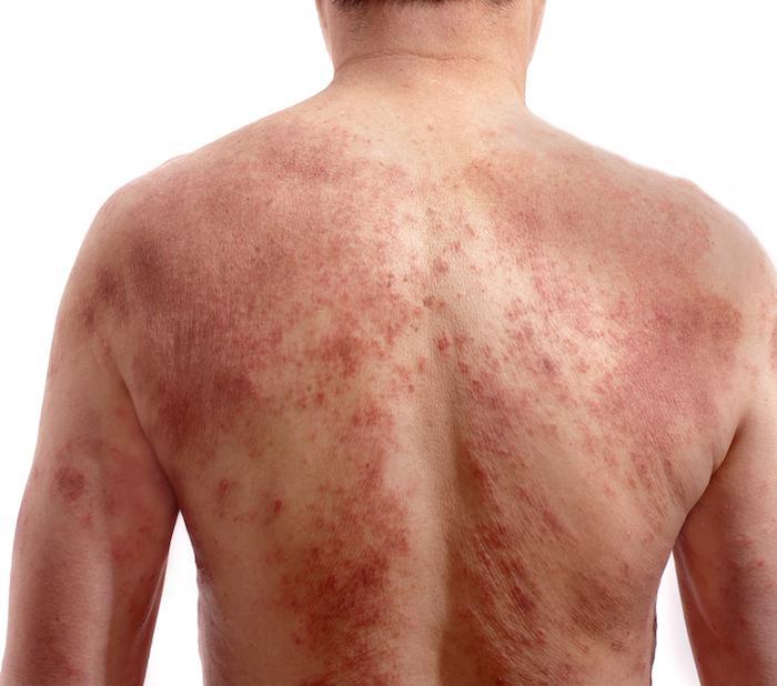 Common Eczema Triggers: Advanced Allergy and Asthma ...
