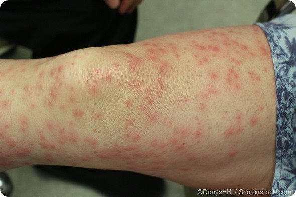 Common Reasons Why Eczema Spread Quickly