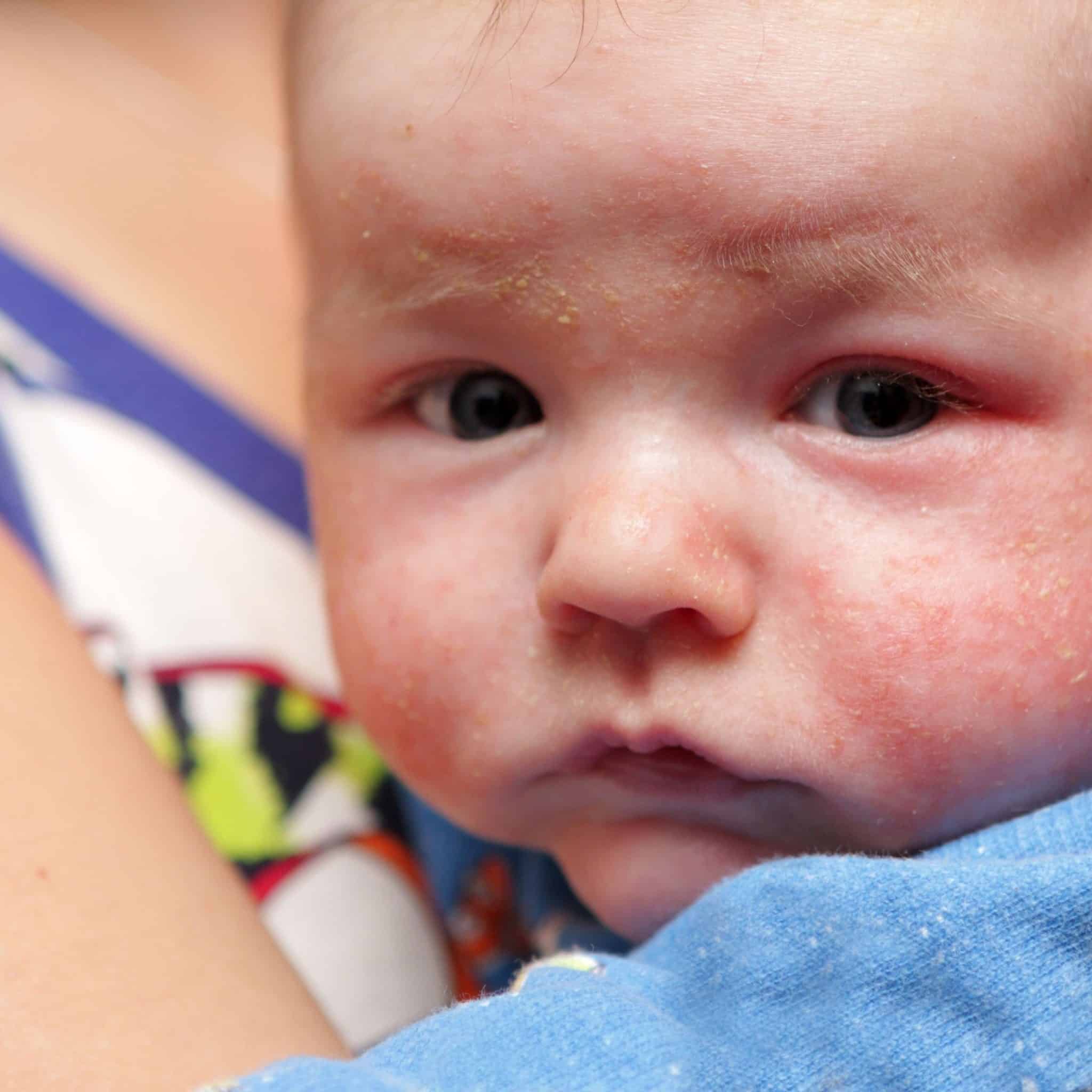 Common skin rashes in children