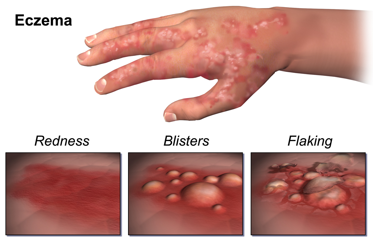 Common Symptoms Of Eczema And Treatments