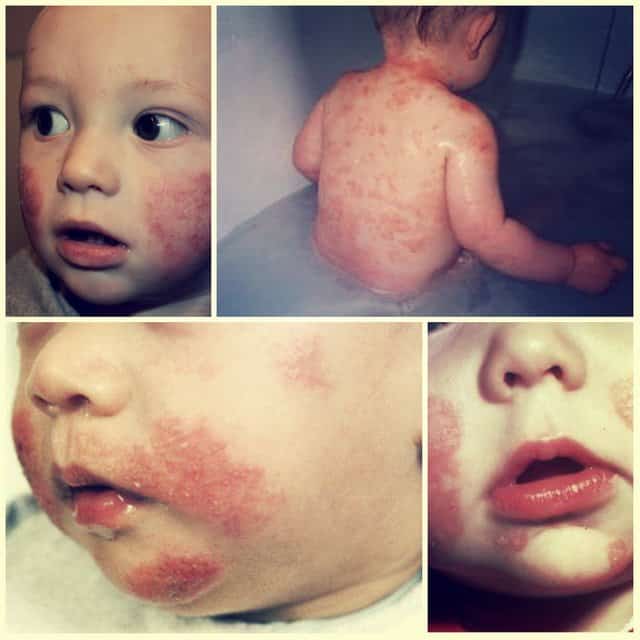 Como Curar La Dermatitis Atopica En Niños