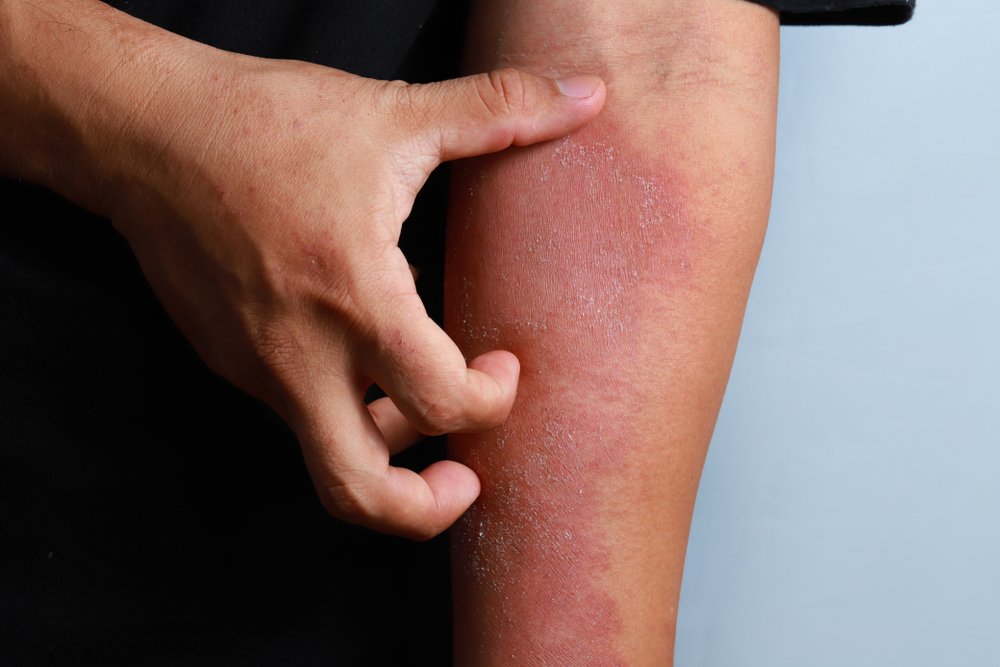 ¿Cómo puedo curar el eczema en la piel?