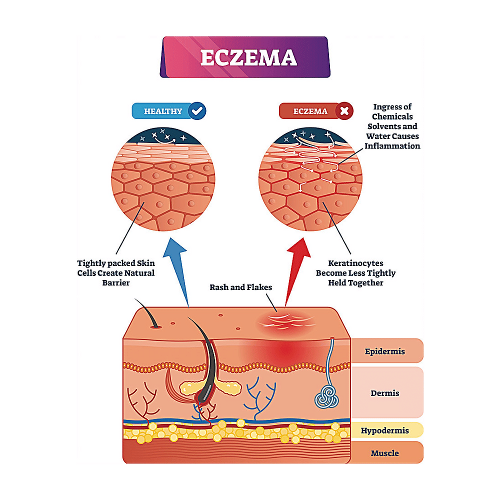 CONCERNS: Dermatitis/Eczema