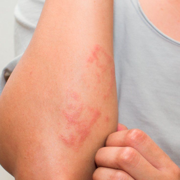 Contact Dermatitis Causes + Natural Treatments