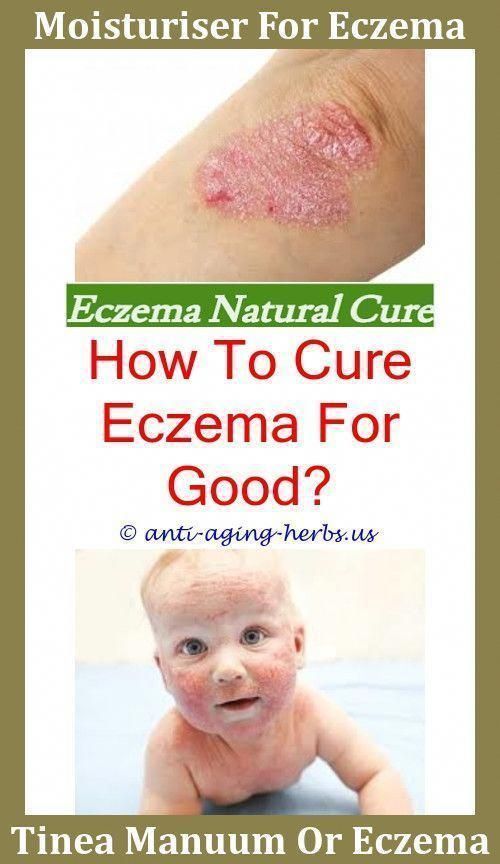 Contact Eczema Toddler Eczema Eczema Remedies For #adults ...