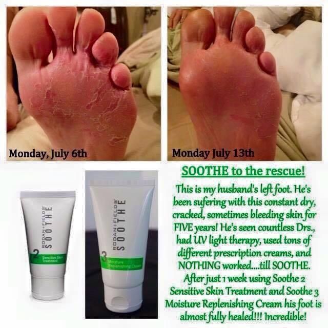 Cracked scaly skin on your feet? Try Soothe #Eczema #Rosacea