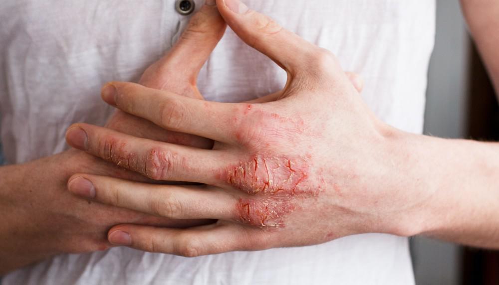 Dealing With Eczema and Psoriasis Flare