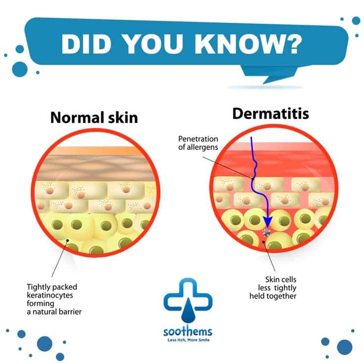 Dermatitis Affected Skin vs. Healthy Skin...Do you know the difference ...