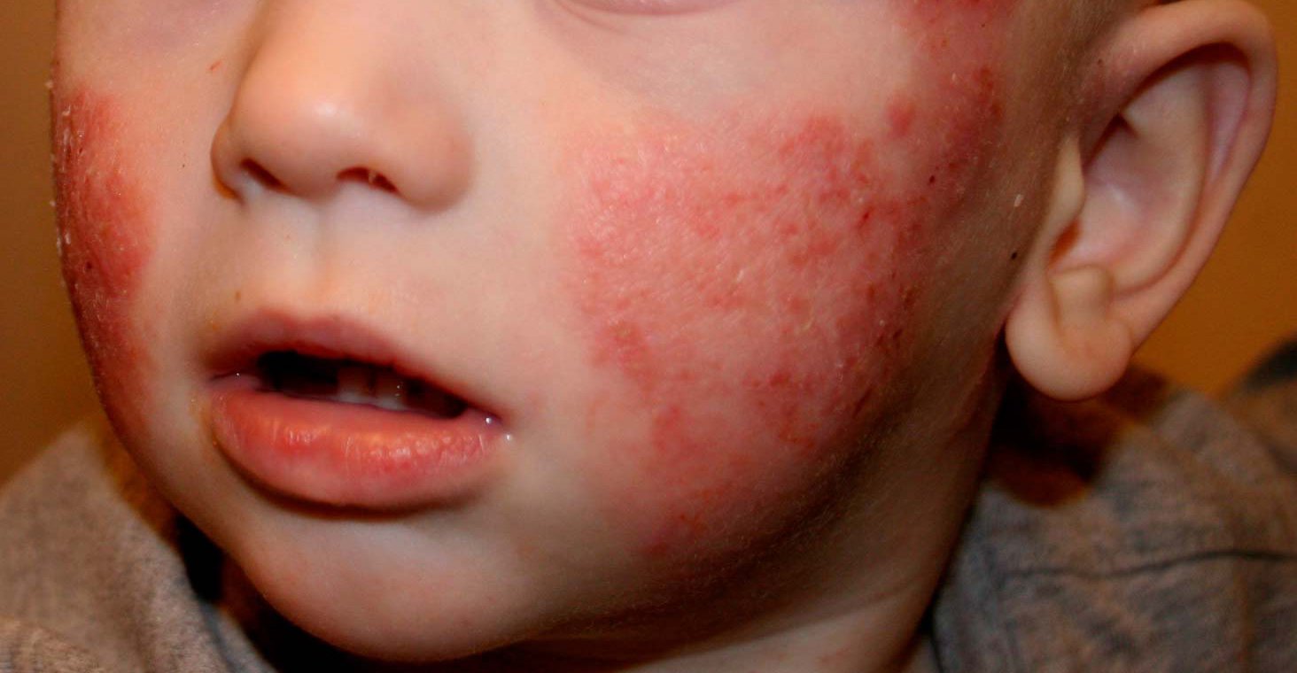Dermatitis atópica, la importancia de cuidarse desde niños