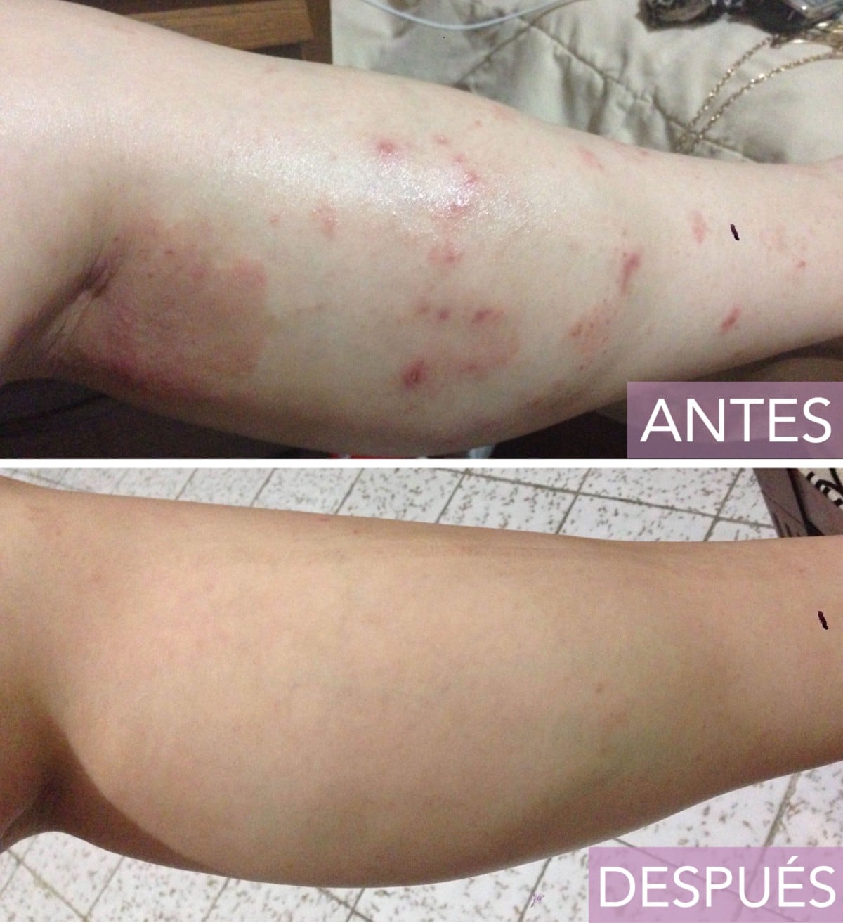 Dermatitis Atópica: ¿Un problema sin solución?