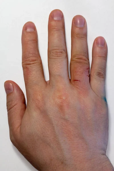 Dermatitis de manos. Eczema de mano  Foto de stock © d19p76 #174373438