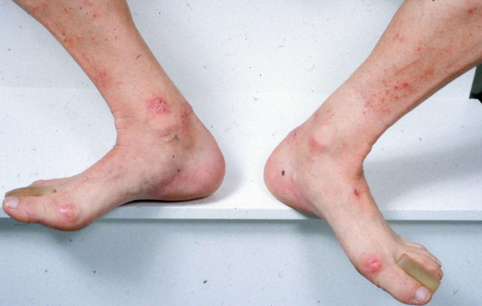 Dermatitis Herpetiformis (Celiac Disease Rash) Photos