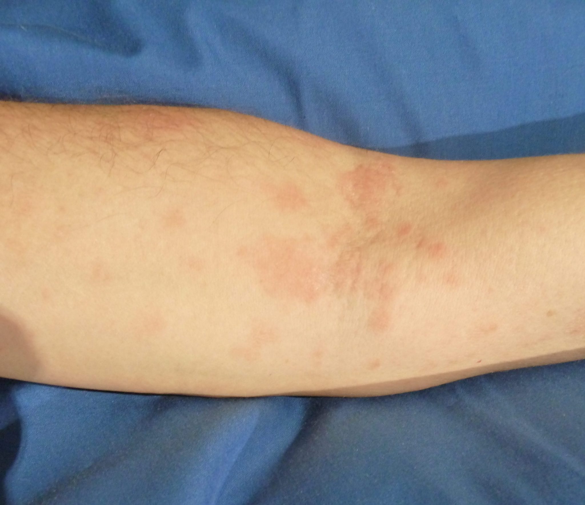 Dermatitis o Eczema