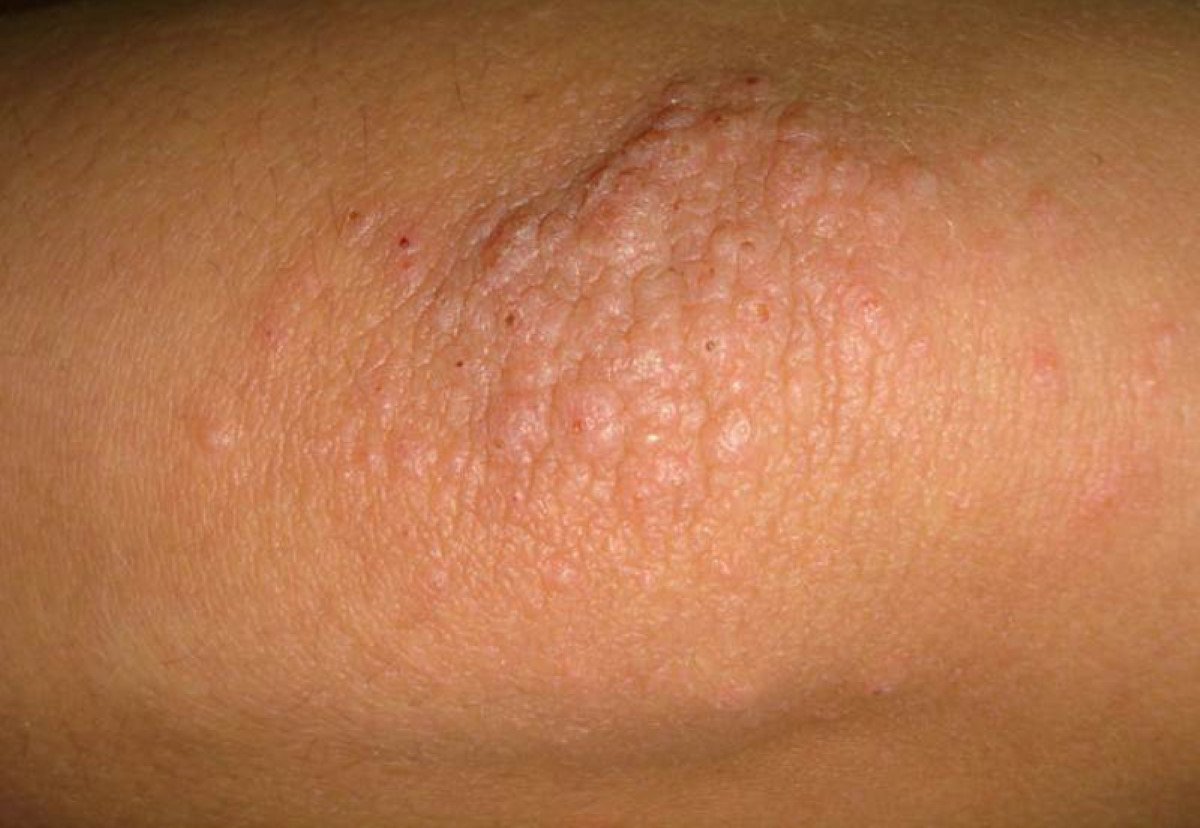 Dermatitis on elbow pictures