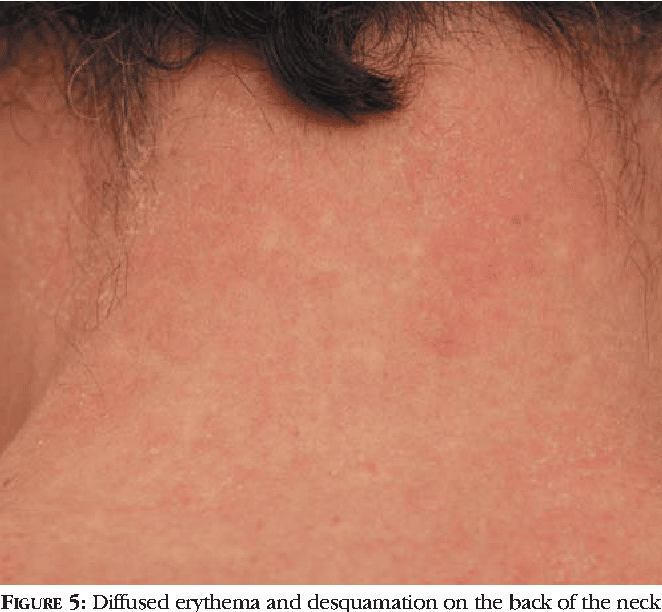 Dermatitis On Neck Pictures