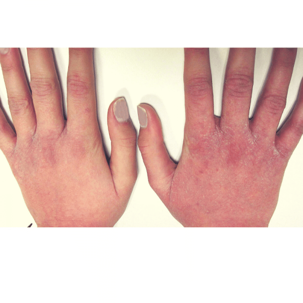 Dermatitis por lavado de manos