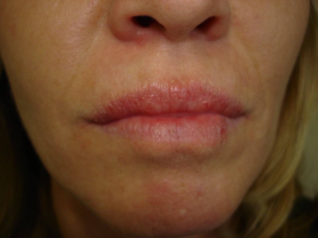 Dermatology For Dentists and Dental Students: Lips