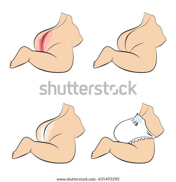 Diaper Dermatitis Baby Redness On Childs Stock Vector (Royalty Free ...