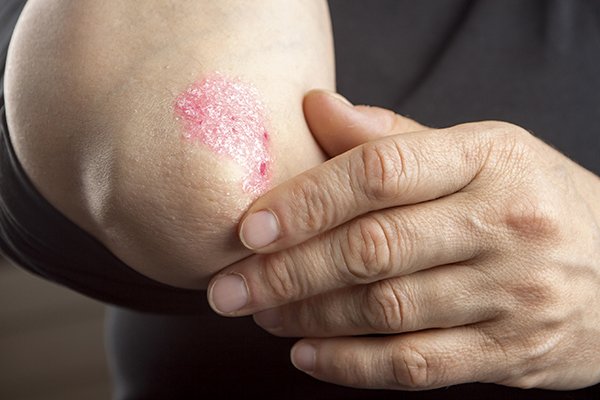 Difference Between Eczema and Psoriasis: Do You Know the Difference ...