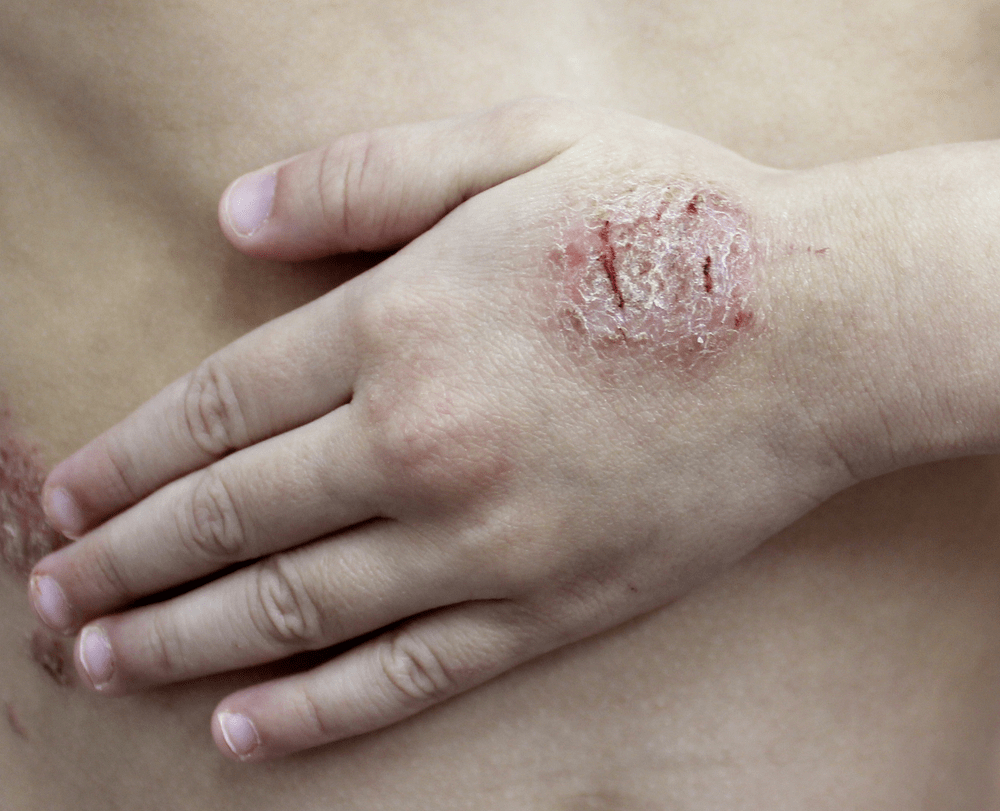 Difference Between Nummular Eczema and Ringworm