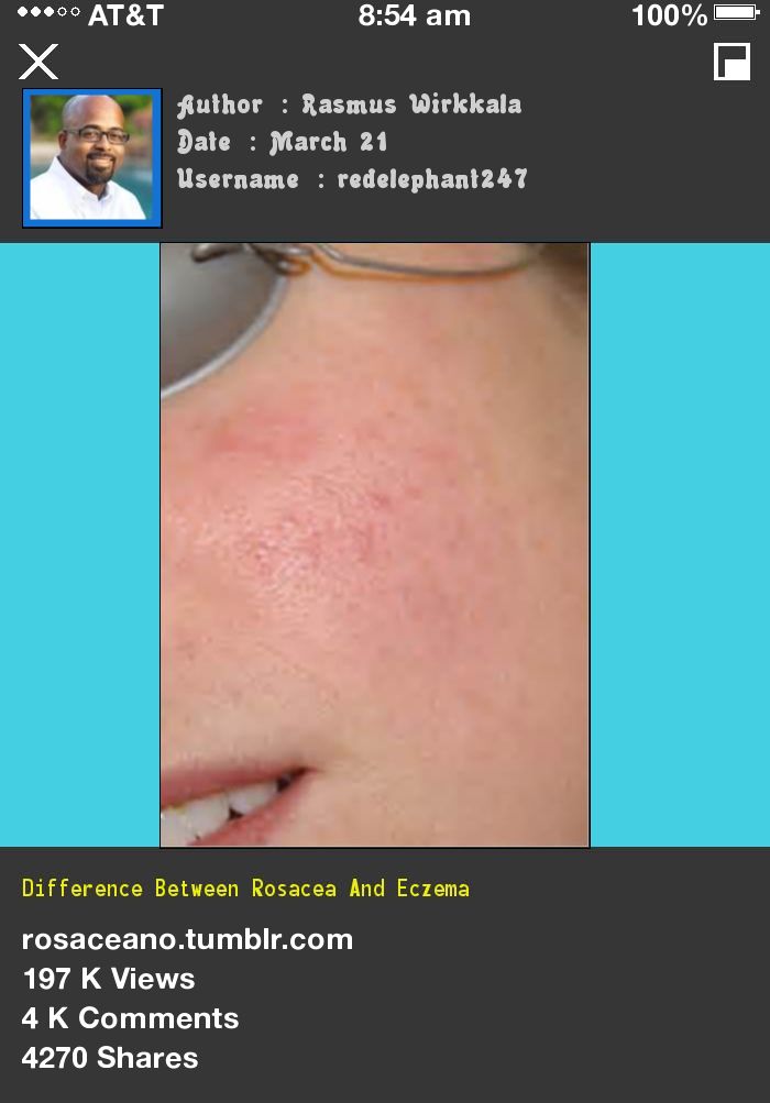 Difference Between Rosacea And Eczema 042908