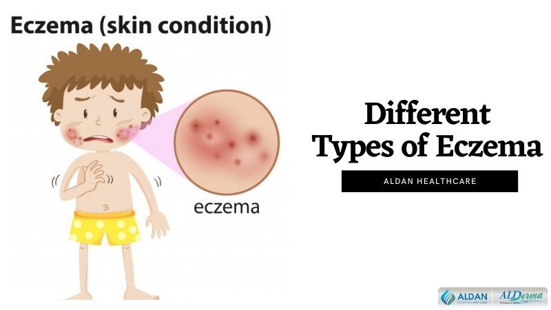 Different Types of Eczema