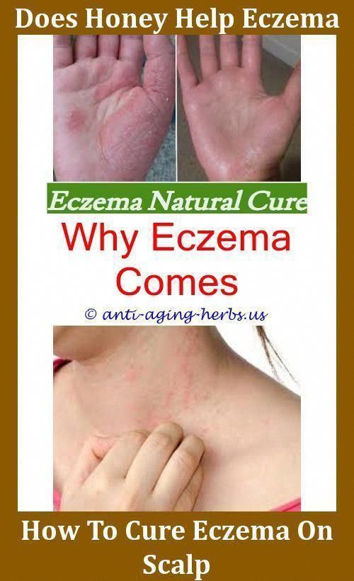 Discoid Eczema Lutein For Eczemawhy is my eczema getting worse.Eczema ...