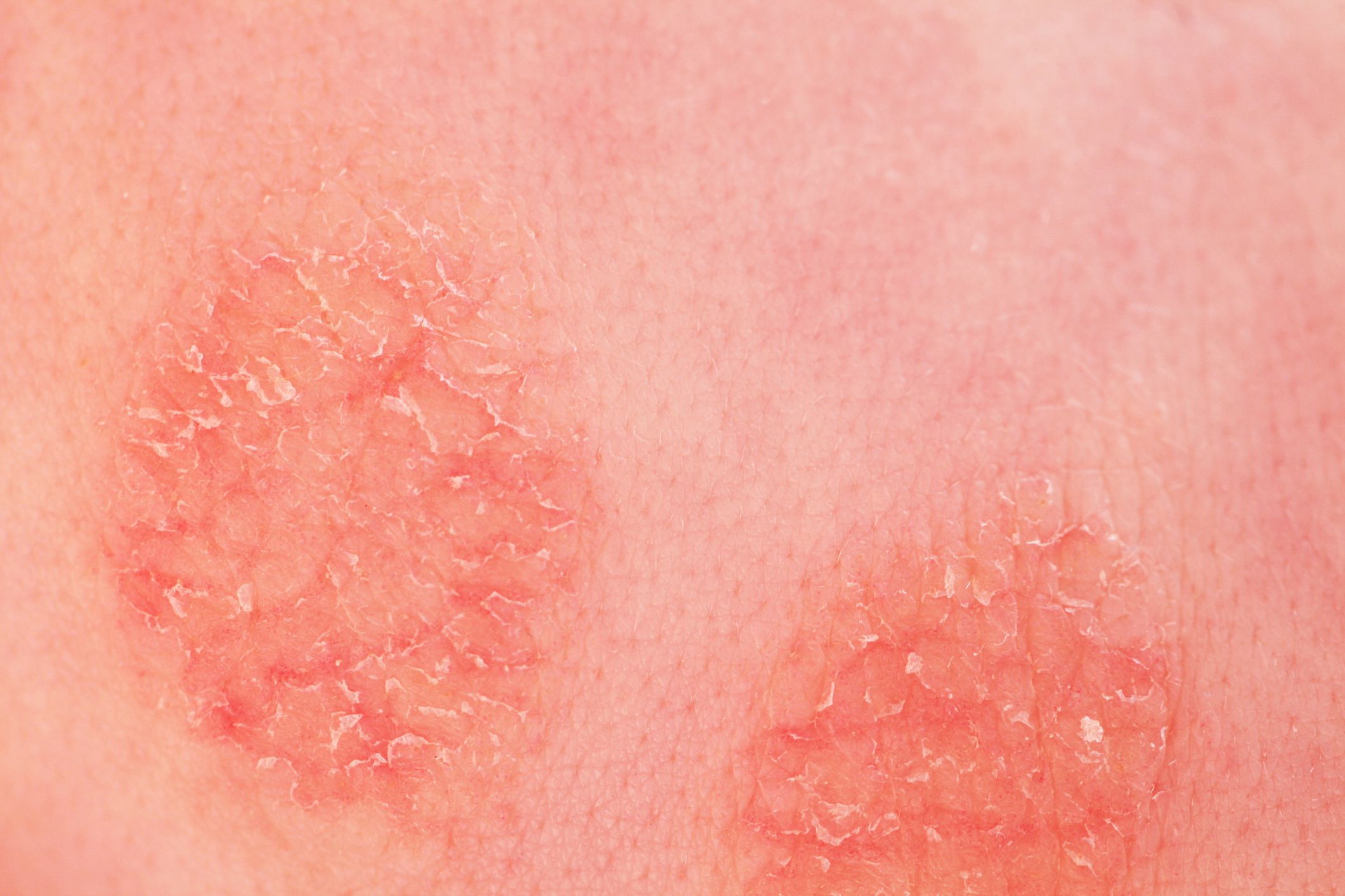 Discoid Eczema: Symptoms, Causes, Diagnosis, Treatment, and Coping